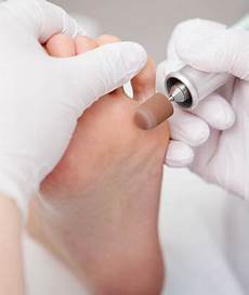 Callus Remover