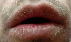 Chapped Lips