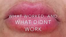Chapped Lips