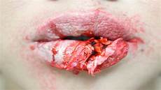 Chapped Lips