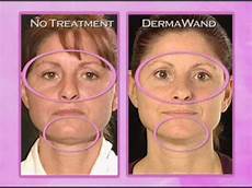 Derma Wand