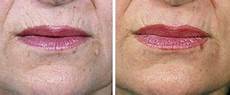 Derma Wand