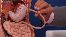 Diabetes Diet