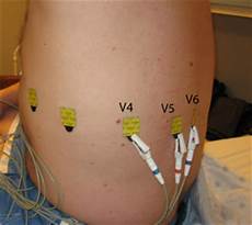 Ekg Leads