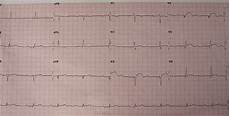 Ekg Leads