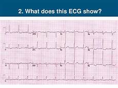 Ekg Leads