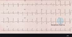 Ekg Leads