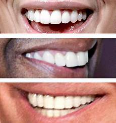 Fake Teeth