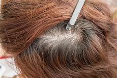Hair Loss Solution