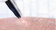 Hair Removal Machine
