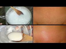 Hair Removal Machine
