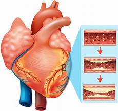 Heart Disease