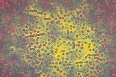 Hepatitis A