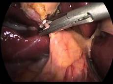 Hepatitis A