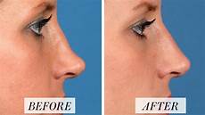 Hyaluronic Acid Liquid