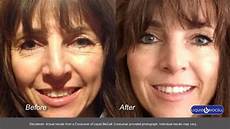 Hyaluronic Acid Liquid