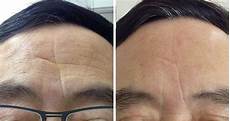 Hyaluronic Acid Liquid