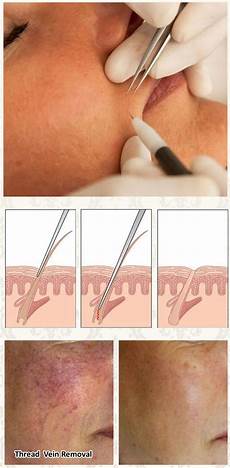 Ipl Hair Removal Machine