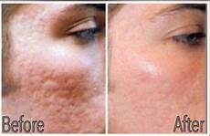 Ipl Hair Removal Machine