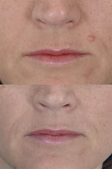 Laser Hair Removal Machine