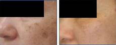 Laser Pointer Age Spot