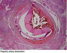 Liver Disorders