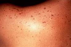 Liver Spots