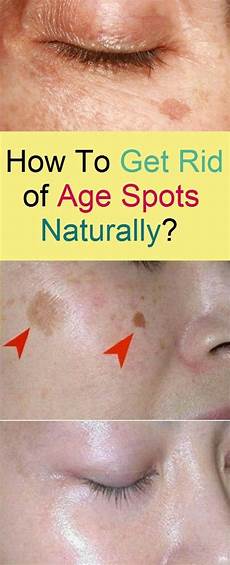Liver Spots