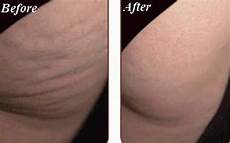 Mesotherapy Machine