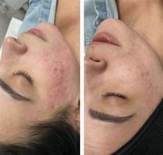 Microdermabrasion Machine