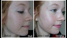 Microdermabrasion Machine
