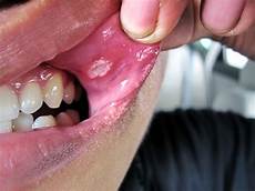 Mouth Ulcers