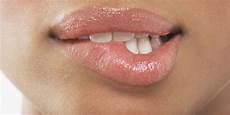 Mouth Ulcers