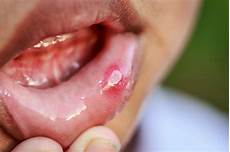 Mouth Ulcers