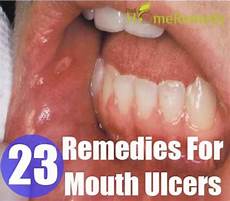 Mouth Ulcers
