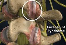 Neck Pain Treatment