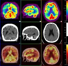 Neurological Disorders