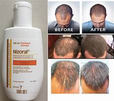 Nizoral Shampoo