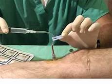 No Needle Mesotherapy Device