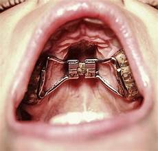 Orthodontic Toothbrush