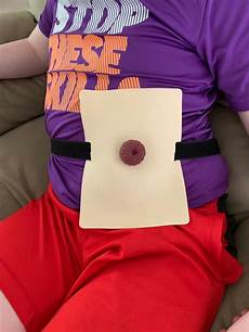 Ostomy Supplies