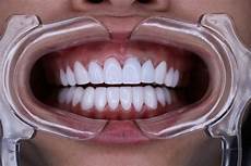 Porcelain Veneers