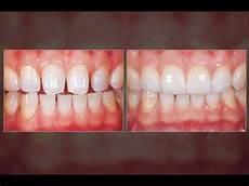Porcelain Veneers