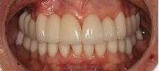 Porcelain Veneers