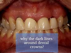 Porcelain Veneers