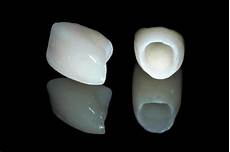 Porcelain Veneers