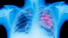 Radiation Detection