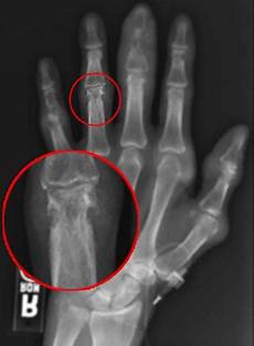 Rheumatoid Arthritis