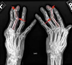 Rheumatoid Arthritis