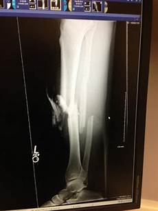 Screws